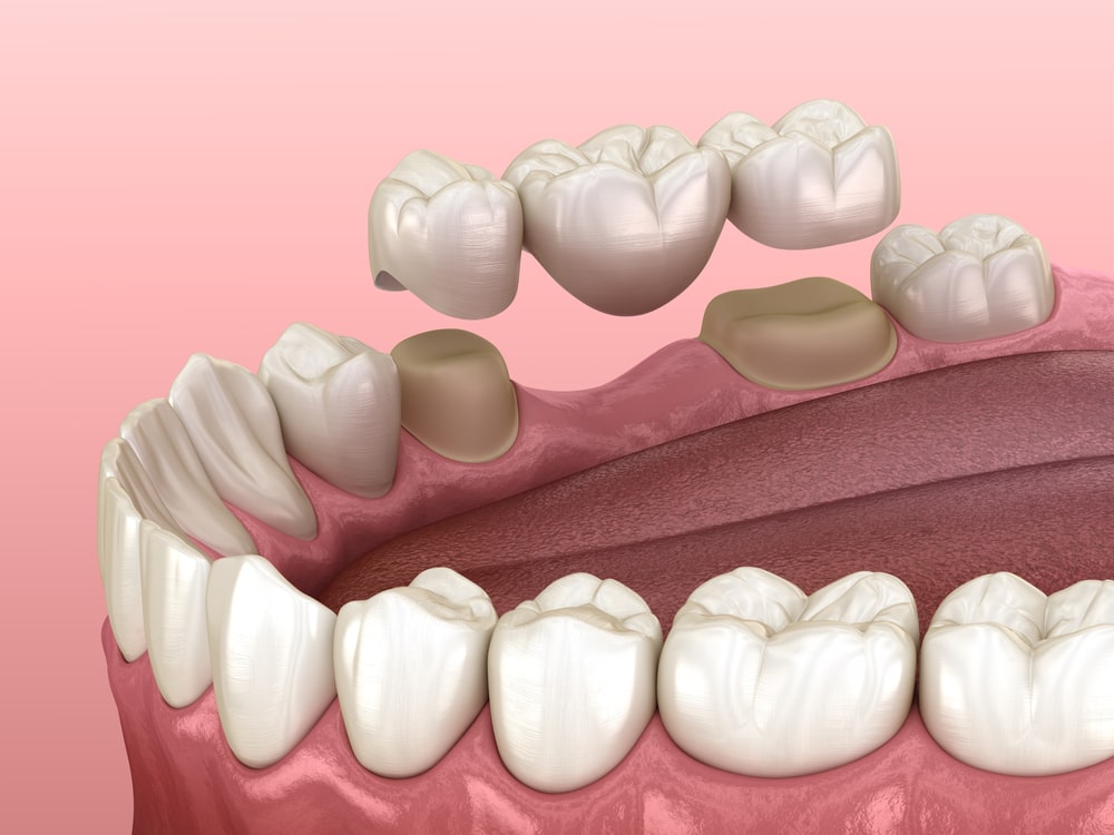 Tooth Bridges