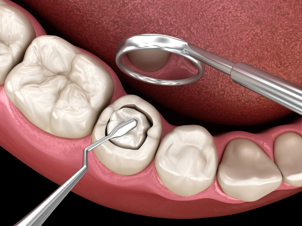 Tooth Composite