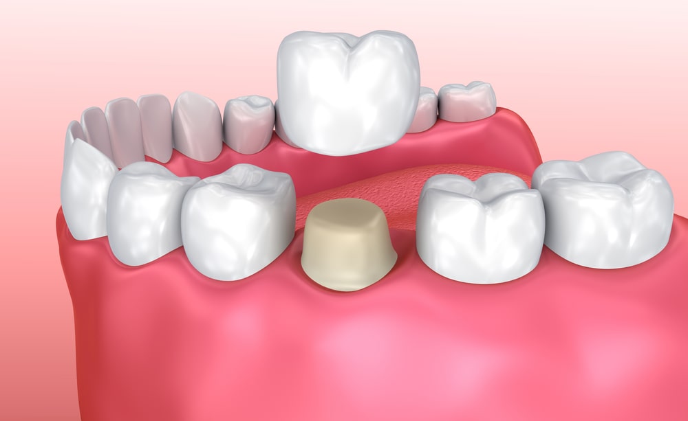 Tooth Crown