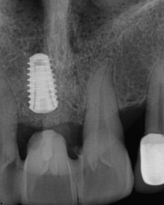 Dr. Rushik Dhaduk implant